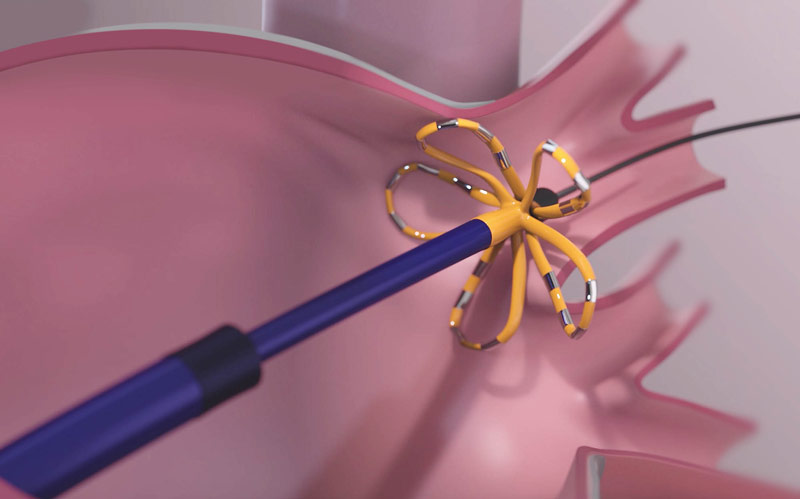 Πολυηλεκτροδιακός καθετήρας Pulsed Field Ablation στην πνευμονική φλέβα