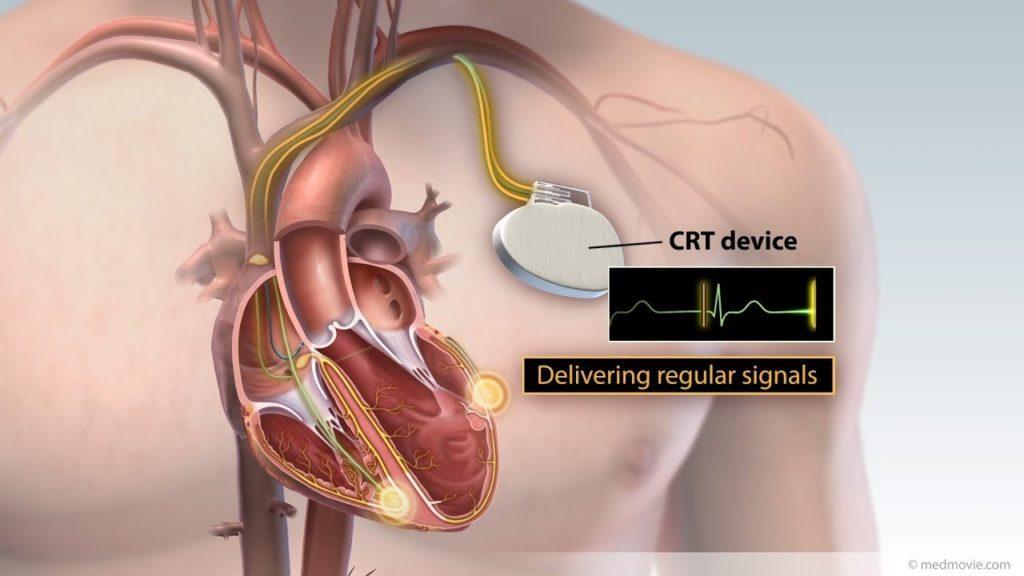 Σχηματική απεικόνιση συστήματος CRT-P και ηλεκτροδίων στην καρδιά
